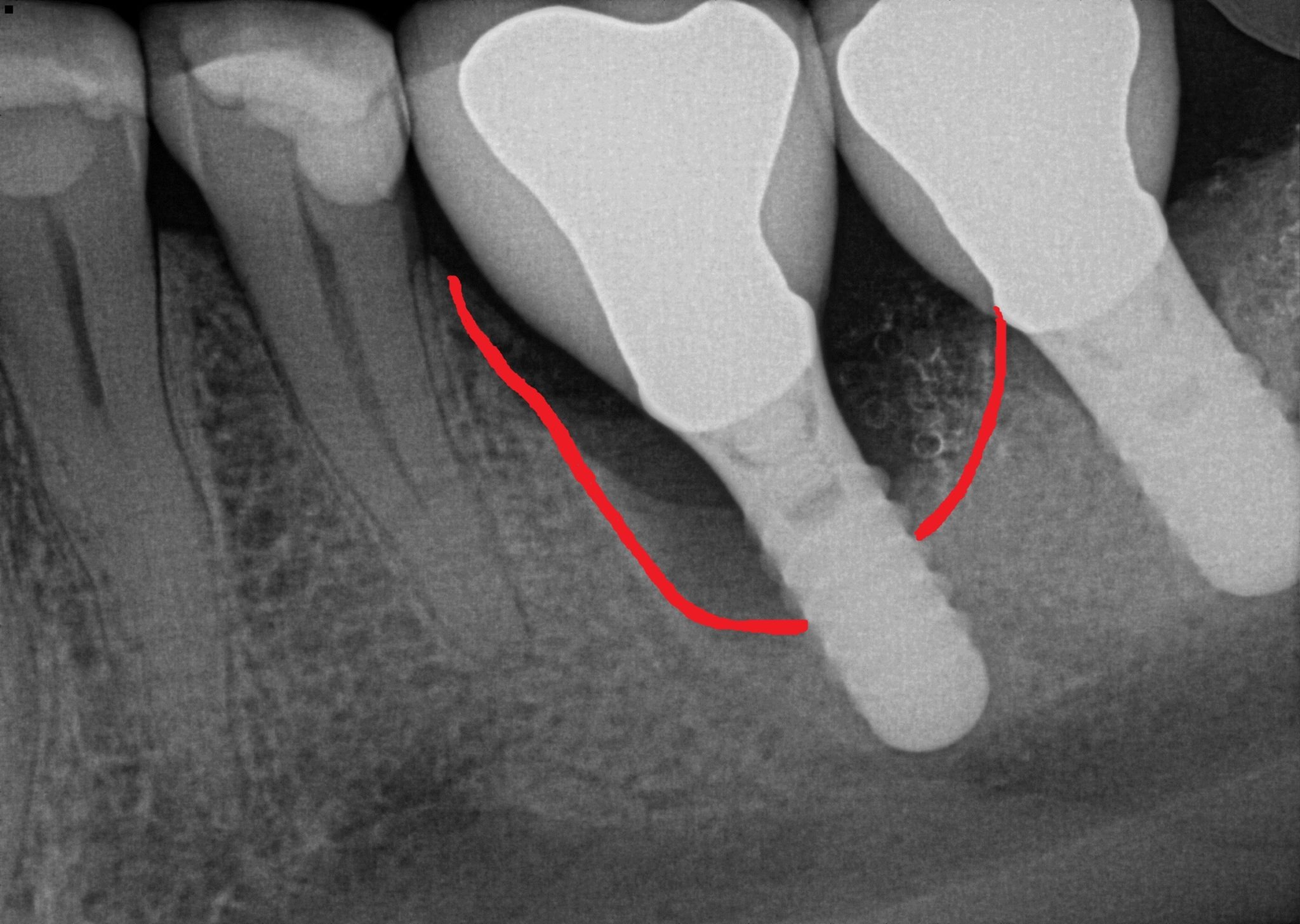 Implant complication case X-ray before treatment
