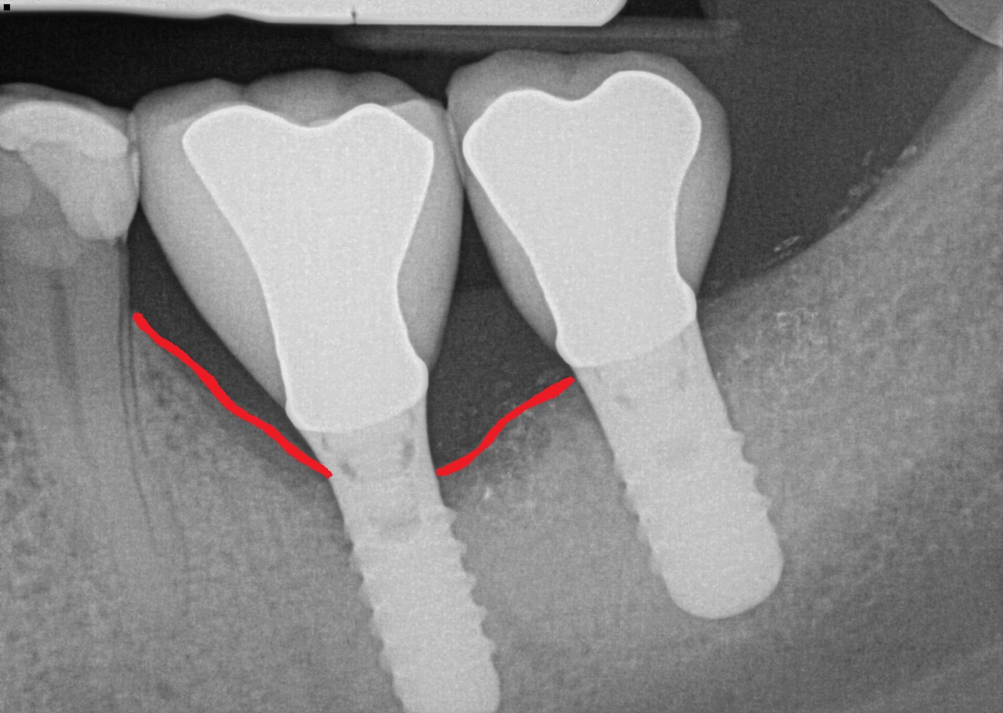 Implant complication case X-ray two years after treatment
